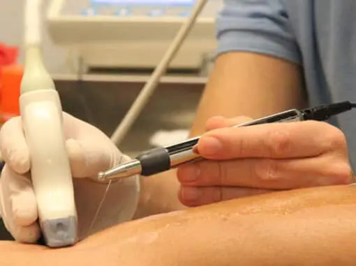 Neuromodulación - Técnica de fisioterapia Invasiva