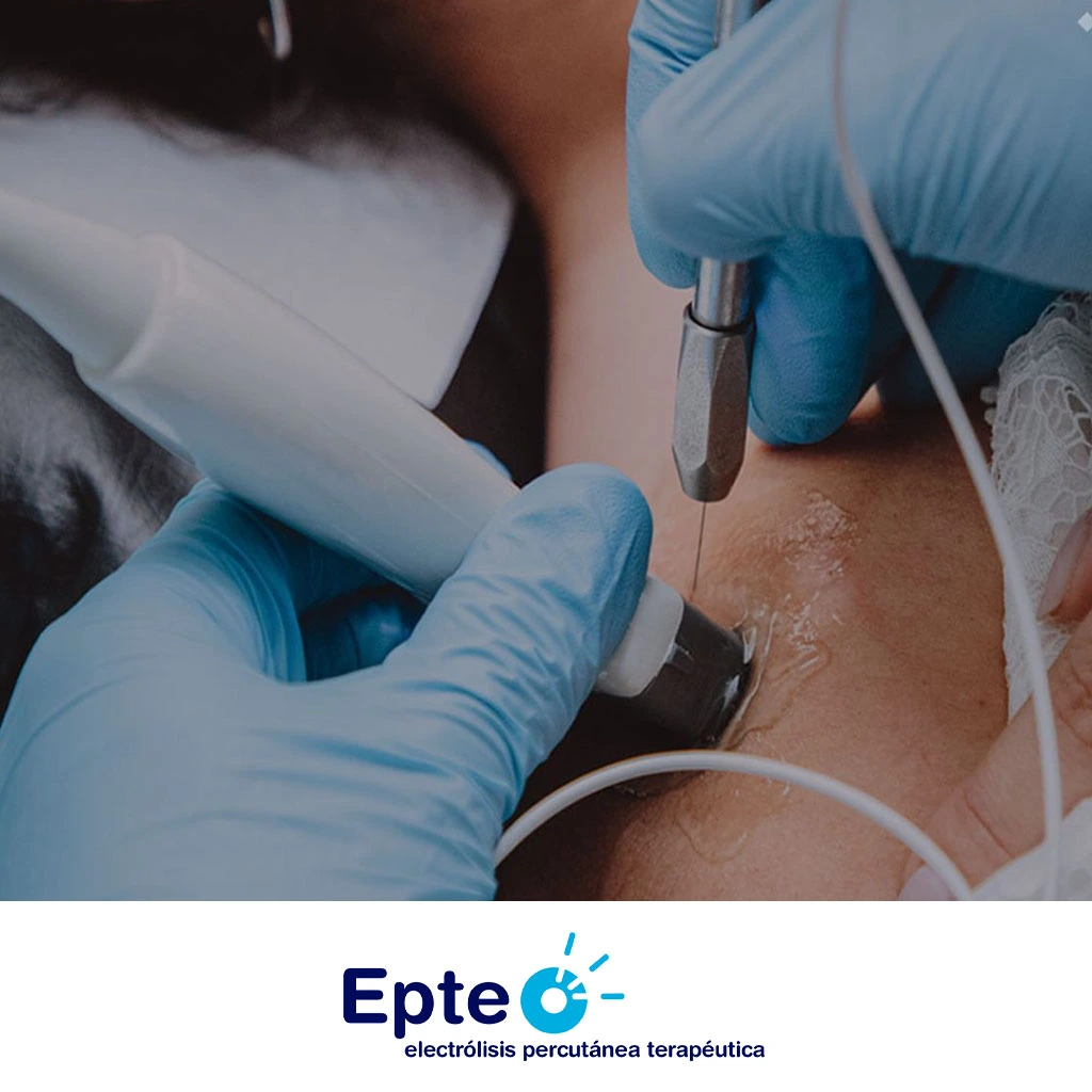 Fisioterapia Invasiva - EPTE